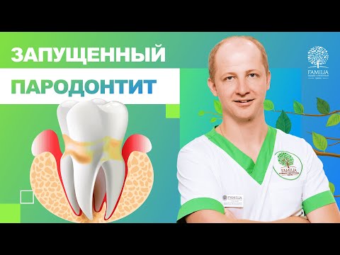 😟 Запущенный пародонтит