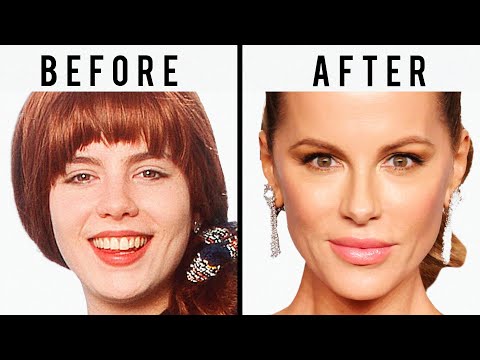 Kate Beckinsale's NEW FACE | Plastic Surgery Analysis