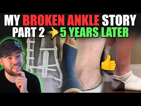 My Broken Ankle Story: Part II - 5 Years Later (Trimalleolar Fracture)