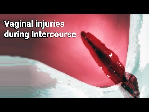 Vaginal injuries during intercourse