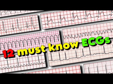 ECG Rhythms every Medical Professional must know! 🚀