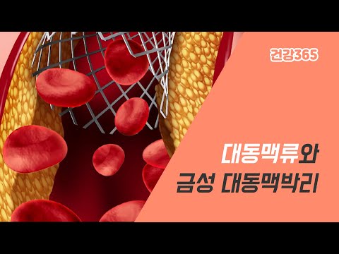 대동맥류와 금성 대동맥박리 [TBC클리닉건강365]