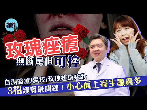 玫瑰痤瘡無斷尾但可控 自測暗瘡/濕疹/玫瑰痤瘡症狀 用錯方法醫慘變爛面｜3招護膚最關鍵！不建議用冰敷冷敷紓緩紅腫｜醫Sick醫識［CC字幕］#玫瑰痤瘡 #暗瘡 #濕疹 #皮膚科 #皮膚病 #am730