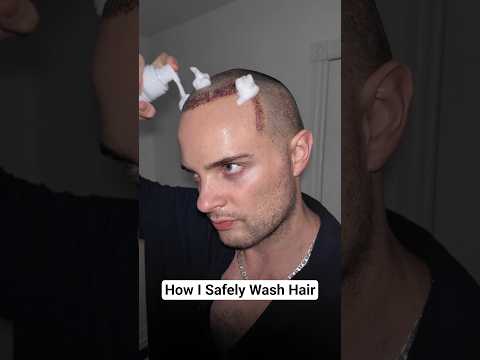 First Wash After Getting a Hair Transplant @SmileHairClinic