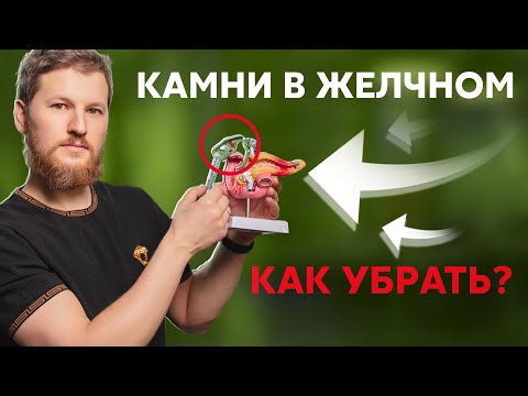 Камни в желчном пузыре - как убрать?