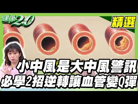 小中風是大中風警訊！必學2招逆轉讓血管變Q彈，預防中風危機！【健康2.0精選】