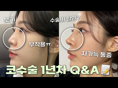 Rhinoplasty Review📝 | My rhinoplasty chronology from the day of surgery to one year ago (How to c...