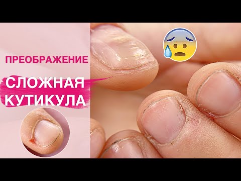 СЛОЖНАЯ налипшая кутикула вся в РАНАХ и трещинах 😰 | Наращивание ногтей полигелем