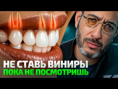 Все виды виниров в 1 видео. Что выбрать в 2026?