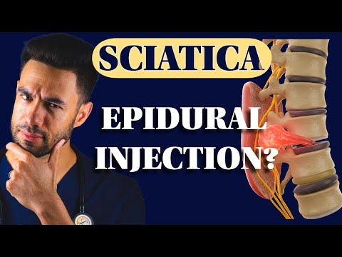 Lumbar Epidural Steroid Injections: 9 Things You NEED to Know!