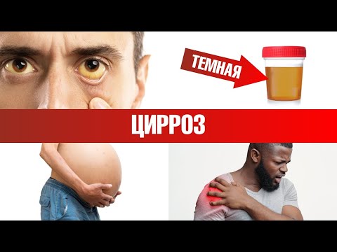 7 главных признаков цирроза печени 📢