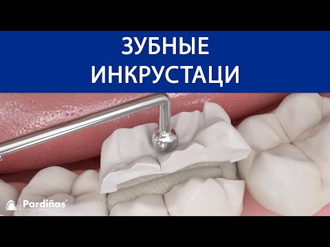 Зубные инкрустации ©