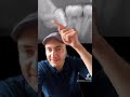 These wisdom teeth cause a lot of damage (dangerous wisdom teeth) #shorts