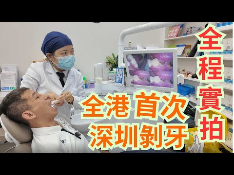 全港首次實拍 ( 深圳剝牙全過程 ) 電腦檢查, 照x光, 剝牙, / 香港5份1價錢 /