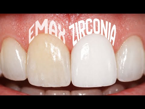 eMax Vs. Zirconia: Which one should you get in Turkey?