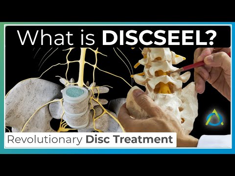 Discseel - Revolutionary Treatment for Chronic Back Pain | Game-Changing Relief Without Surgery
