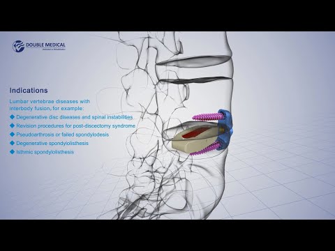 Double Medical OLIF Cage System