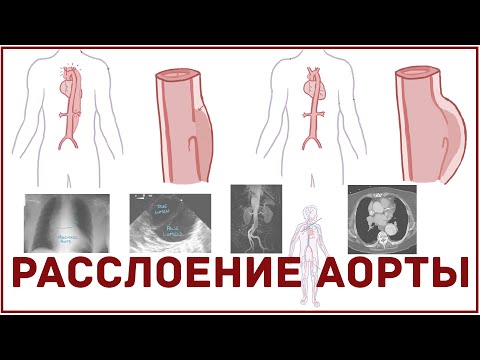 Расслоение аорты - причины, симптомы, диагностика, лечение - кратко