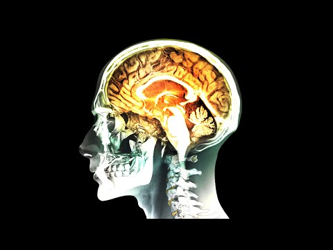 A Woman Drank "35% Food Grade Hydrogen Peroxide." This Is What Happened To Her Brain.