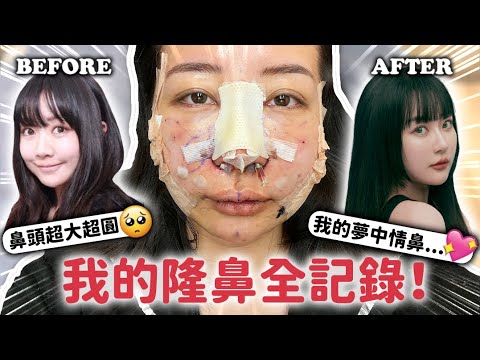 最真實的整形紀錄：隆鼻痛嗎？花多少錢？恢復期多久？｜蘿倫 Lauren ft.依心唯美整型外科 謝東穎醫師 @followheart