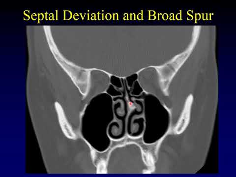 Imaging of the Paranasal Sinuses 2