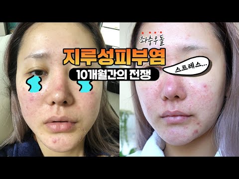 지루성 피부염으로 고생한 10개월간의 기록😂