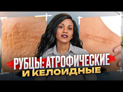 SCARS: we solve the problem radically // Scars after plastic surgery, cosmetology, injuries: what...