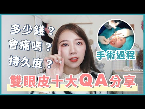 我變雙眼⽪了  雙眼⽪⼗⼤QA分享，找對醫⽣真的很重要！(含雙眼皮手術過程分享)