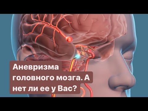 АНЕВРИЗМА ГОЛОВНОГО МОЗГА. Что это? Как с этим жить?