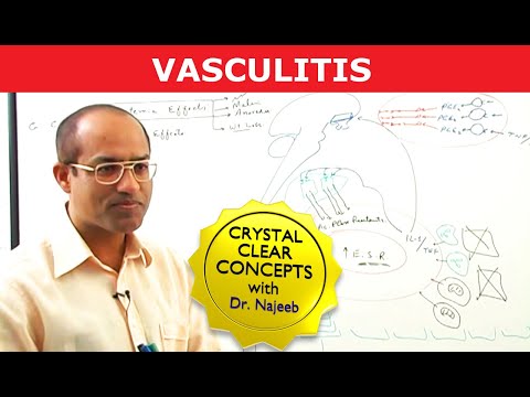Vasculitis | Causes, Symptoms & Treatment