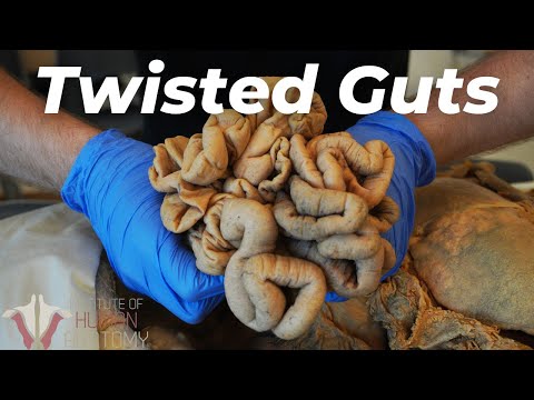 The EXCRUCIATING Anatomy of Bowel Obstructions