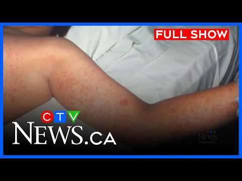 Measles cases growing in Manitoba | CTV News Winnipeg at Six for Feb. 13, 2026