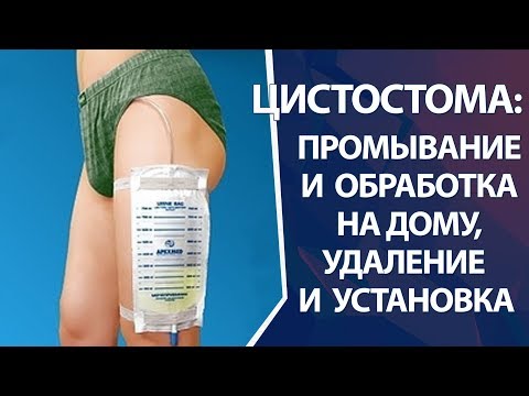 Цистостома: замена и промывание цистостомы на дому и в клинике, установка и удаление цистостомы
