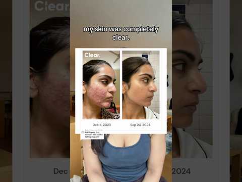 I tracked my whole skincare journey on my free skincare app Clear #acne #skincare #dermatology
