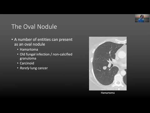Approach to the solitary pulmonary nodule
