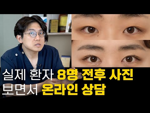 (온라인 상담)실제 환자 8명 /절개,비절개,두줄따기,눈매교정/ 자신의 눈과 비교해 보세요