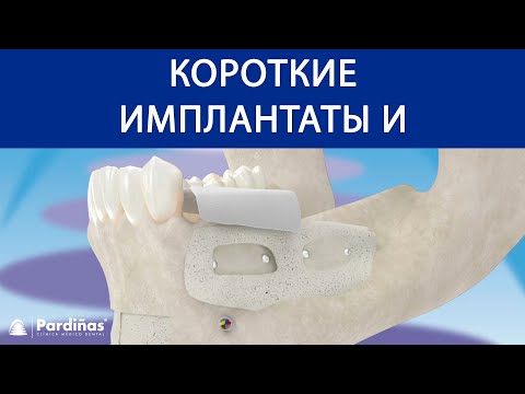 Короткие имплантаты и увеличение высоты альвеолярной кости ©