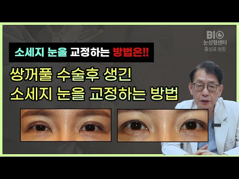 쌍꺼풀 수술후 생긴 소세지 눈을 교정하는 방법 - BIO성형외과 홍성표원장