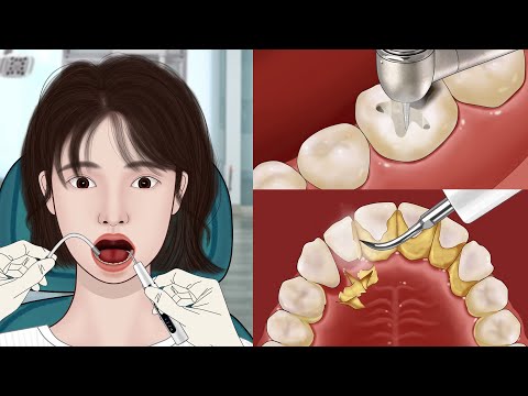 ASMR Dental Treatment Animation 🦷 Satistfying Tartar & Caries Removal | Meng's Stop Motion
