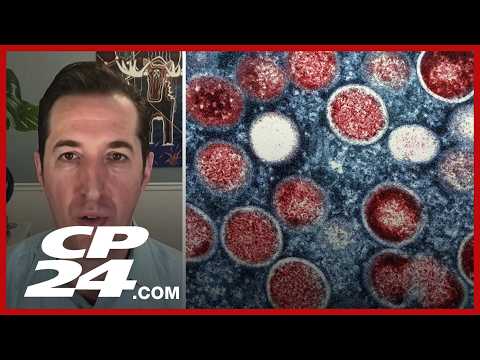 New MPOX variant detected in Toronto ‘may be more transmissible than other strains’: Dr. Bogoch
