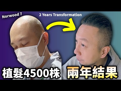 在日香港人，日本植髮4500株兩年結果！費用如何？後頭部狀況公開㊙