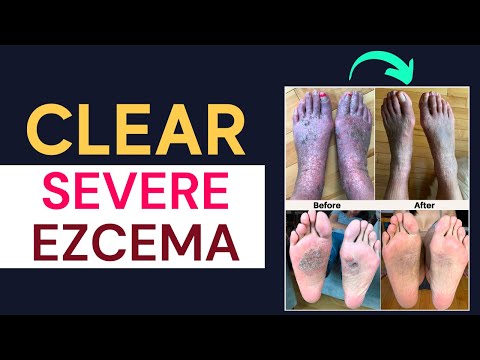 Eczema TREATMENT Plan (Especially For HIDDEN Eczema Triggers) | Jennifer Fugo