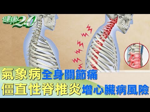 氣象病全身關節痛 僵直性脊椎炎增心臟病風險 健康2.0