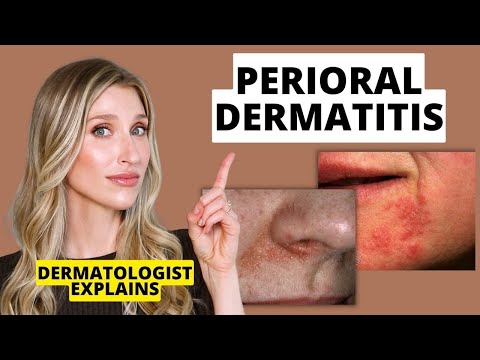 Dermatologist Explains Perioral Dermatitis (What it Looks Like, Causes, & Treatments) | Dr Sam Ellis