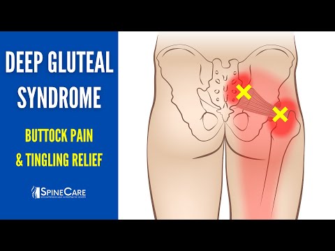 30 SECOND FIX: Deep Gluteal Syndrome (Buttock Pain & Tingling Relief)