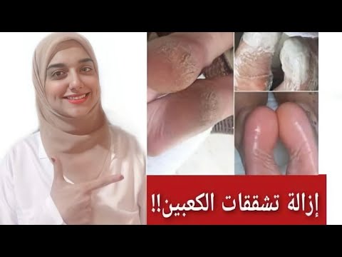 أسهل و أسرع طريقة للتخلص من تشققات الكعبين من اول استخدام