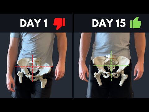 The Best Resource On The Internet For Fixing Lateral Pelvic Tilt (asymmetrical hips)