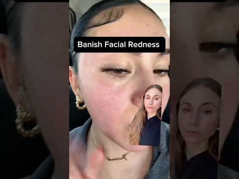 Natural Rosacea Relief That Actually Works #dermatologist