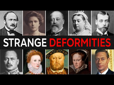 33 British Royals With HIDDEN DISABILITIES And DEFORMITIES | For Sleep