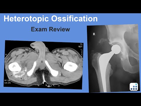 Heterotopic Ossification Exam Review - William Barrett, MD